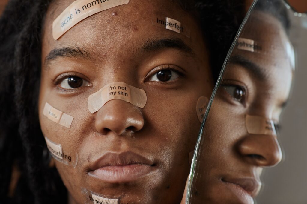 Young woman with acne bandaids on her face